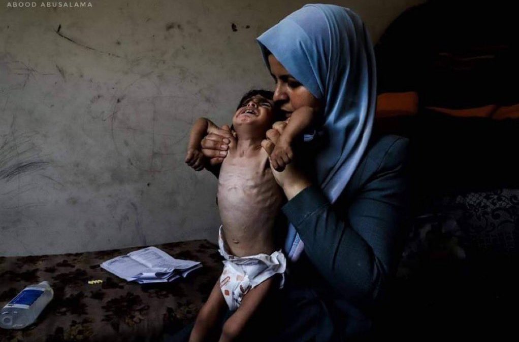 ورقة التوت الأخيرة.. المجاعة بغزة تكشف عورة العالم!