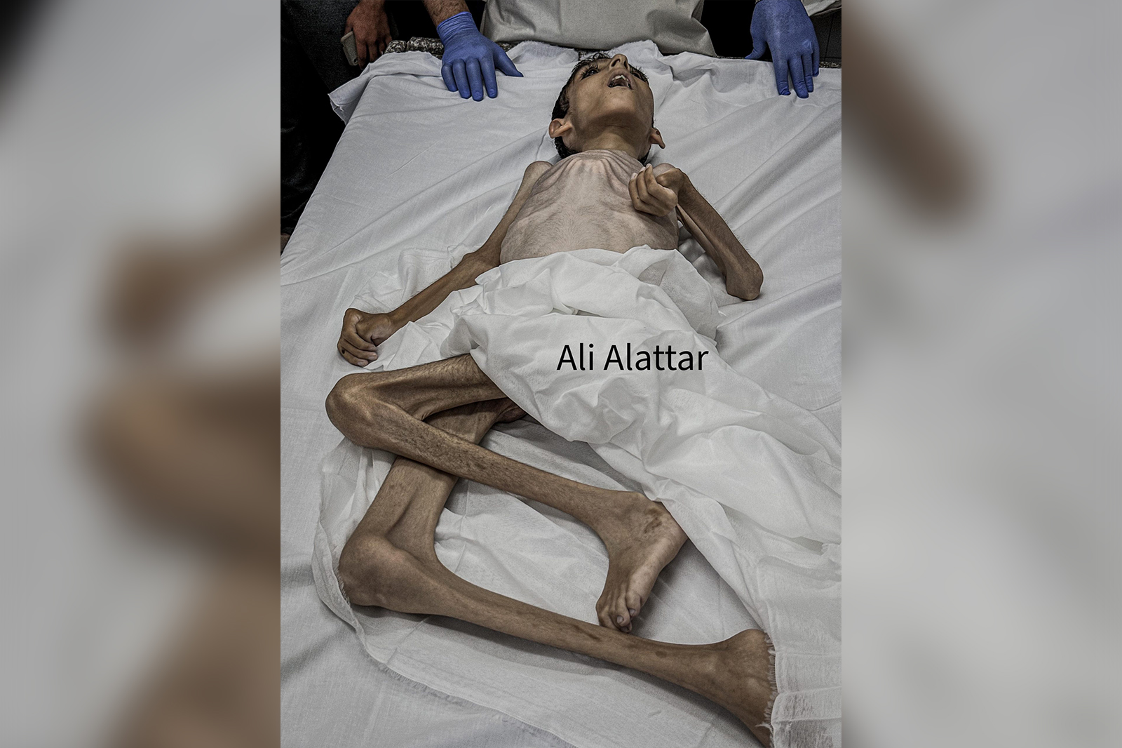 شهيد جديد بسبب المجاعة في غزة شهيد جديد بسبب المجاعة في غزة