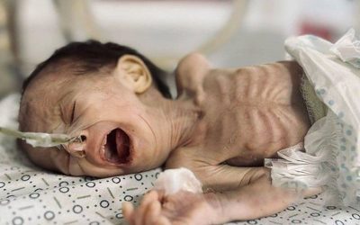 سياسة التجويع تفتك بالأطفال الرضع في غزة