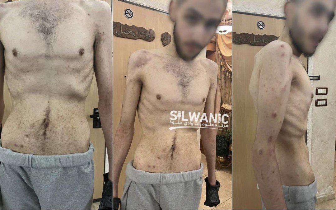 قبور للأحياء .. سجون الاحتلال تفتك بصحة المعتقلين بالتعذيب الممنهج