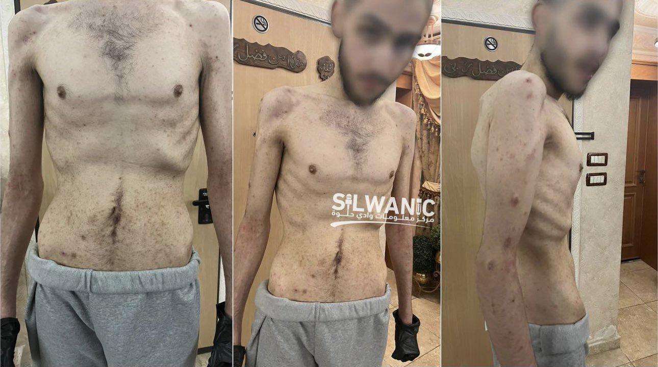قبور للأحياء .. سجون الاحتلال تفتك بصحة المعتقلين بالتعذيب الممنهج قبور للأحياء .. سجون الاحتلال تفتك بصحة المعتقلين بالتعذيب الممنهج