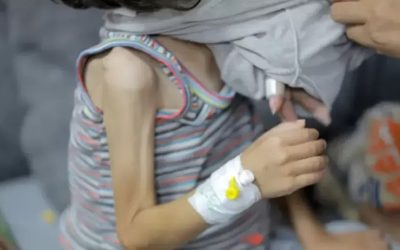 الأونروا: 66 ألف طفل في قطاع غزة يعانون سوء تغذية خطيرا