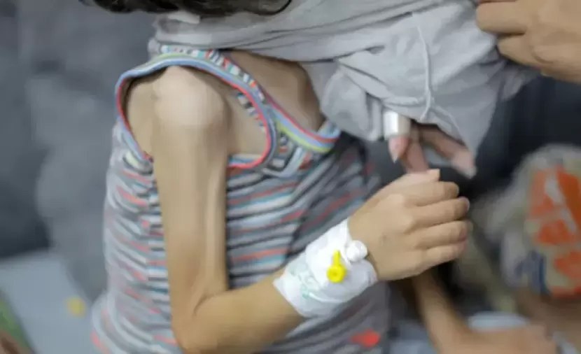 الأونروا: 66 ألف طفل في قطاع غزة يعانون سوء تغذية خطيرا