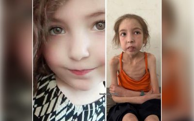 الطفلة رهف عياد .. جسد يتآكل بفعل الحصار والتجويع