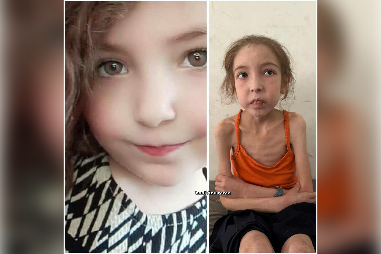 الطفلة رهف عياد .. جسد يتآكل بفعل الحصار والتجويع الطفلة رهف عياد .. جسد يتآكل بفعل الحصار والتجويع