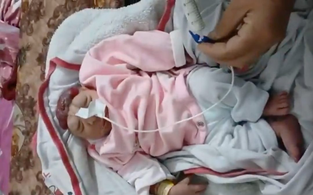 مولودة بلا دماغ.. الطفلة القانوع آخر تجليات جرائم الإبادة بغزة
