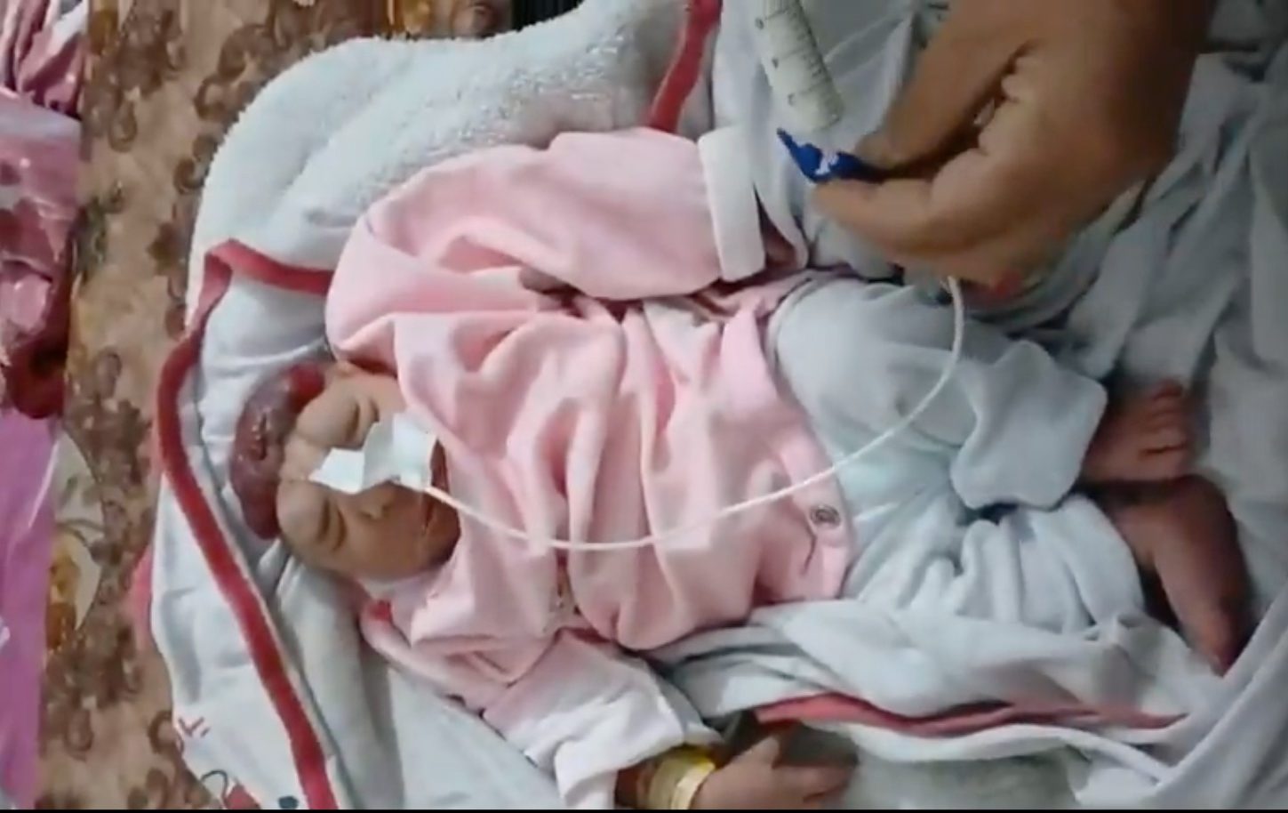 مولودة بلا دماغ.. الطفلة القانوع آخر تجليات جرائم الإبادة بغزة مولودة بلا دماغ.. الطفلة القانوع آخر تجليات جرائم الإبادة بغزة