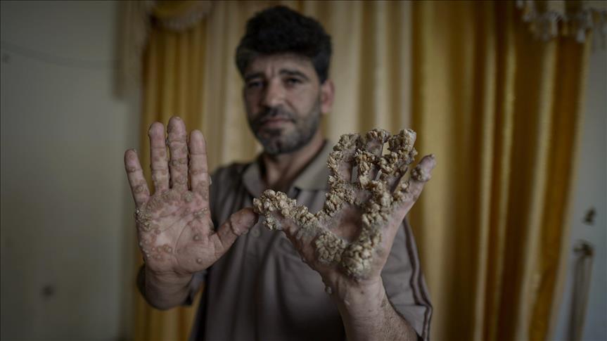 في غزة ..فلسطيني مصاب بمرض رجل الشجرة النادر