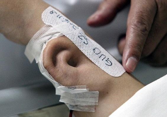 أطباء صينيون يزرعون أذناً في ذراع مريض