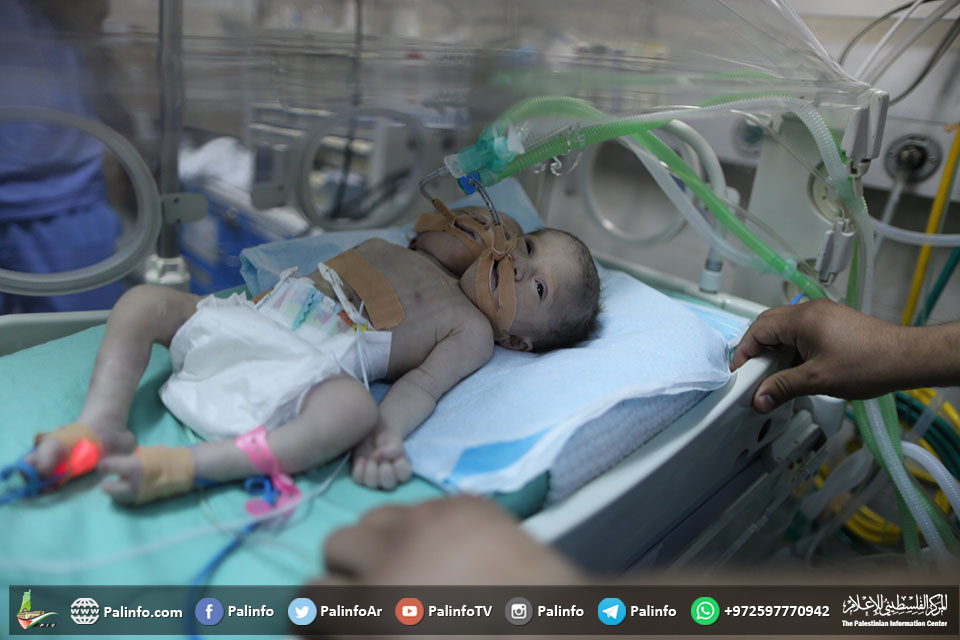 ولادة توأم سيامي برأسين بمستشفى الشفاء بغزة
