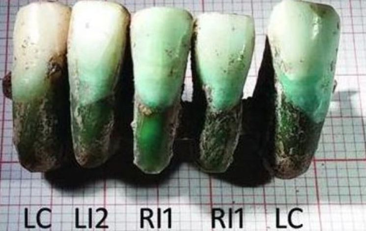 العثور على طاقم أسنان عمره 400 سنة
