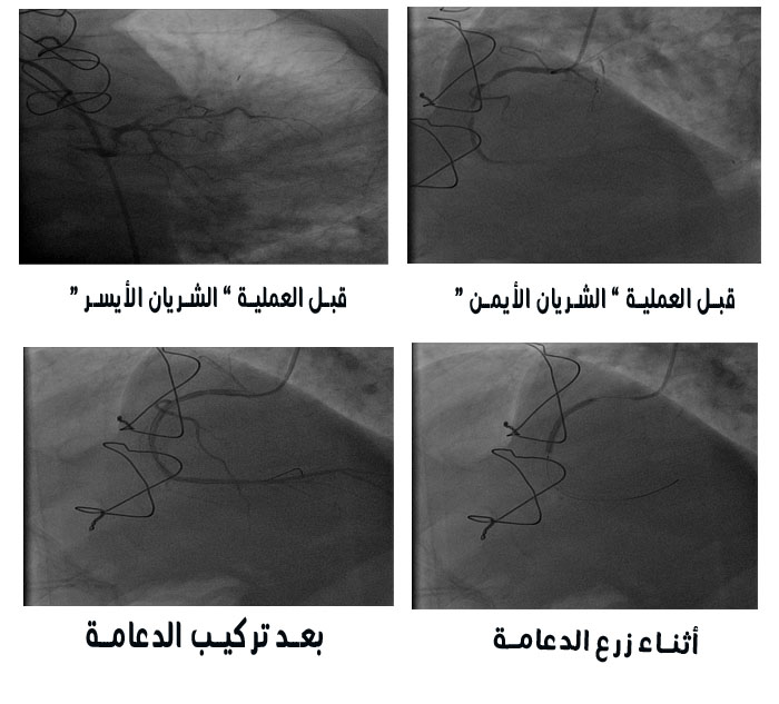 قسطرة القلب بالخدمة العامة تنقذ حياة مريض من الموت قسطرة القلب بالخدمة العامة تنقذ حياة مريض من الموت