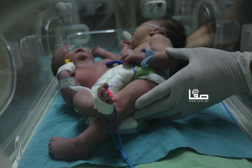 ولادة نادرة لتوأم سيامي في غزة