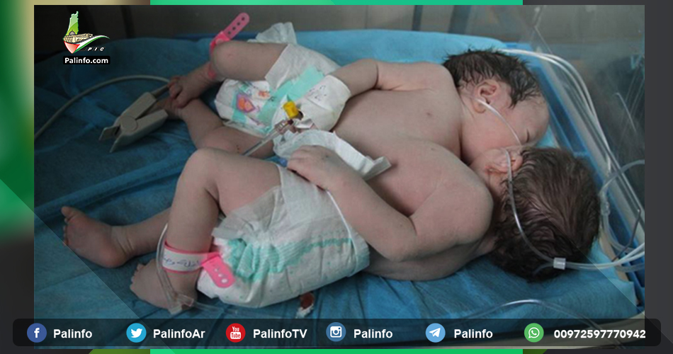 ولادة توأم بقلب واحد بالخليل