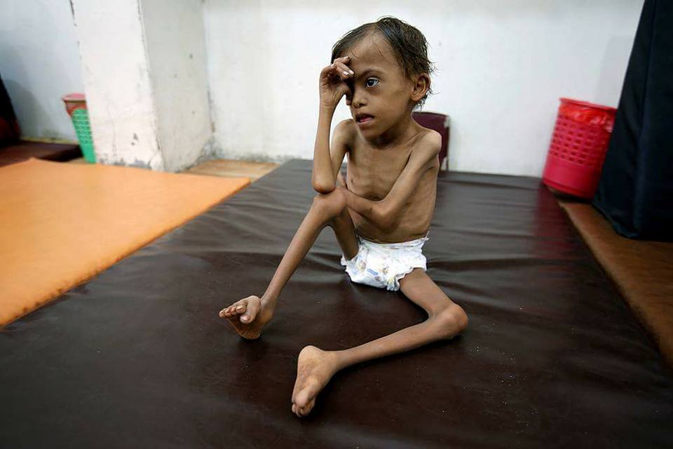الأمم المتحدة: أكثر من 8 ملايين يمني على شفا المجاعة