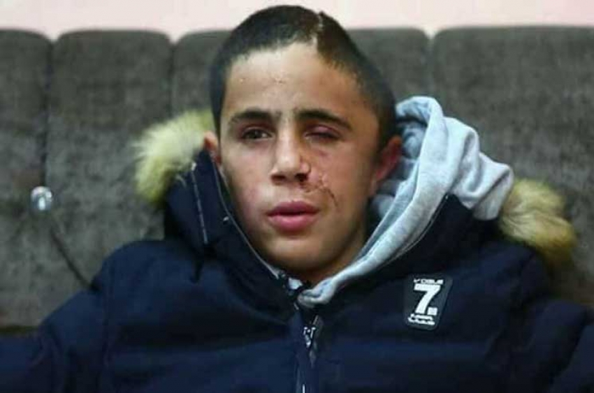 الجيش الإسرائيلي يجبر طفلا على الاعتراف بأن إصابته حادث