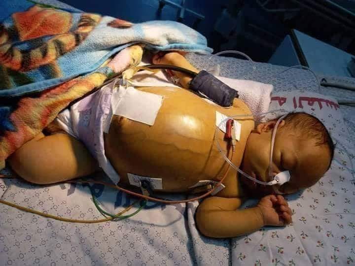 وفاة الرضيع حمزة طومان بعد رفض الصحة تغطية تكاليف علاجه