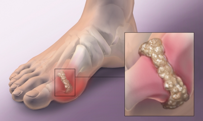 7 أمراض تسبب ألما في إصبع القدم الكبير.. تعرف عليها