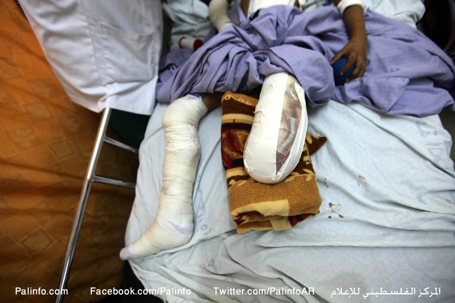 تامر النداوي 12 عاما بترت قدمه بقصف صهيوني على منزل عائلته