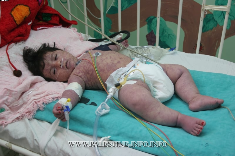 اكتشاف الفيروس المسبب لشلل الأطفال في غزة
